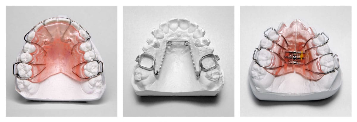 Palatal Expander Devices in Andover, MA