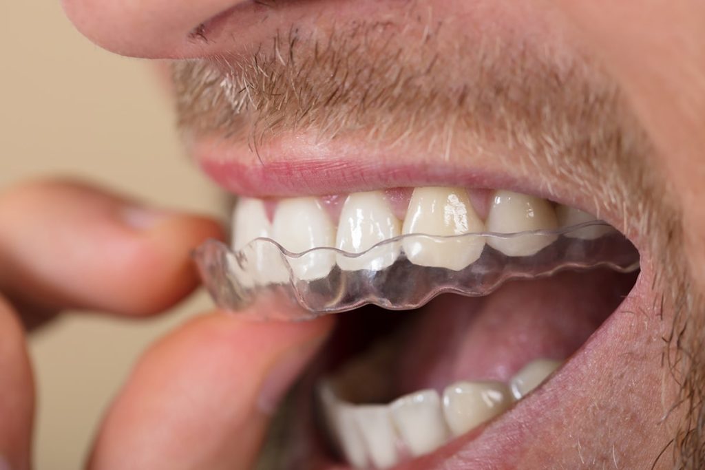 does-insurance-cover-invisalign-andover-ma