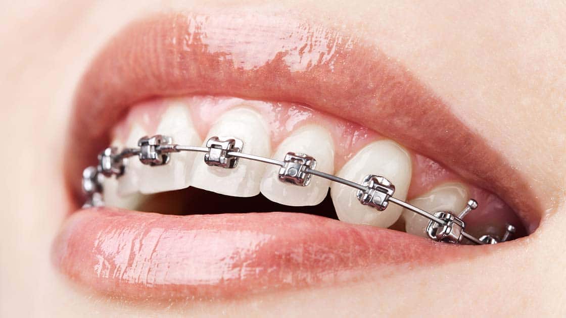 Self Litagating Braces